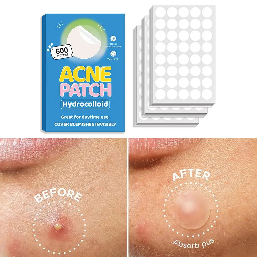 40/360/600/720 Counts Invisible Hydrocolloid Patches For Covering Zits And Blemishes, Acne Pimple Patches For Face Spot Stickers