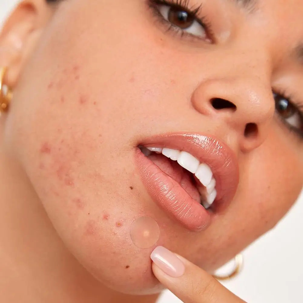 40/360/600/720 Counts Invisible Hydrocolloid Patches For Covering Zits And Blemishes, Acne Pimple Patches For Face Spot Stickers
