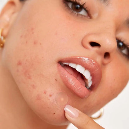 40/360/600/720 Counts Invisible Hydrocolloid Patches For Covering Zits And Blemishes, Acne Pimple Patches For Face Spot Stickers